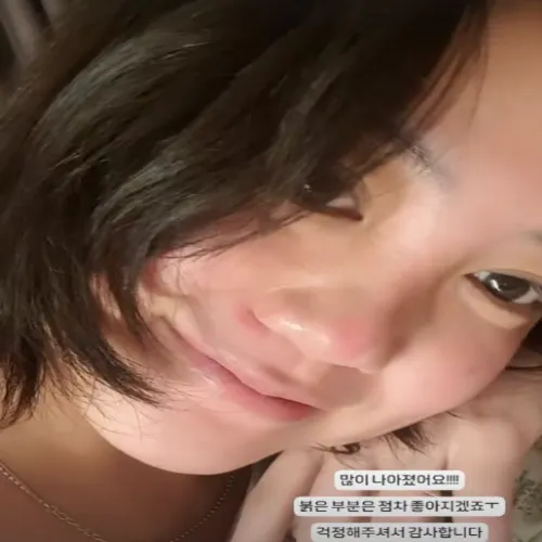 고은아 낙상사고