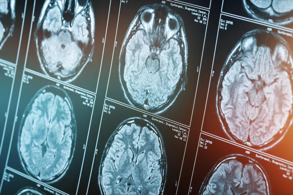 MRI