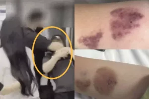 연예인 과잉 경호 논란 관련 상처 이미지