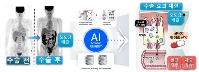 비만대사수술
