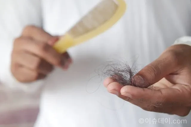 탈모 치료 건보 적용