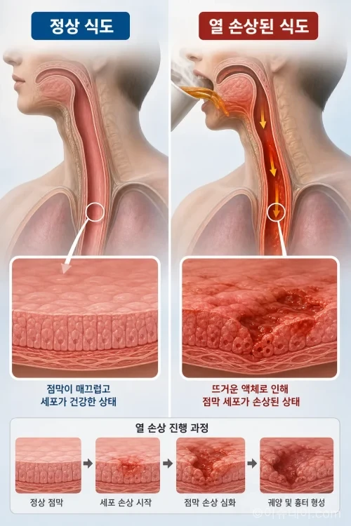 뜨거운 음료로 인해 손상된 식도 점막과 정상 식도 비교 일러스트