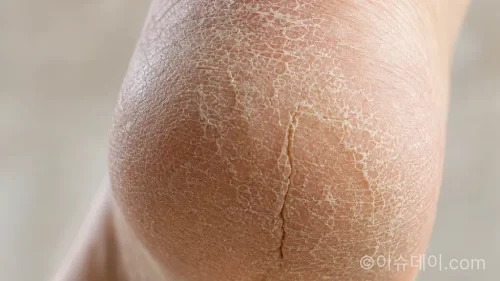 하얗게 각질이 일어나고 갈라진 발뒤꿈치 모습